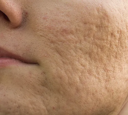 Laser Hair Removal Treatment
